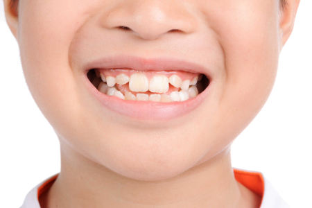 Răng nhiễm flo ở trẻ- Biện pháp xử lý hiệu quả là gì?