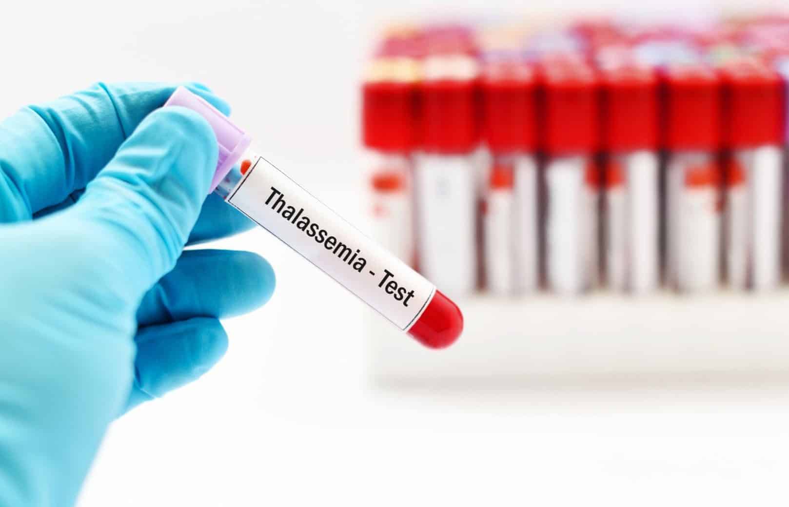 xét nghiệm chẩn đoán thalassemia là gì