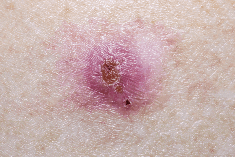 Dấu hiệu ung thư da: Một nốt u tròn như hạt ngọc, trong mờ như sáp