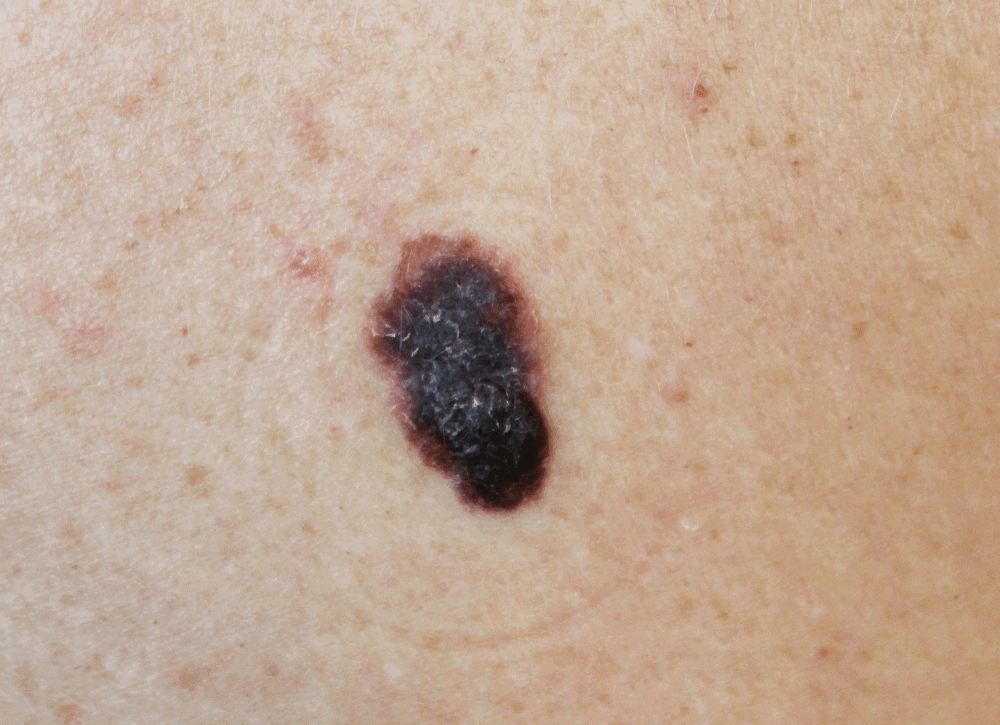 Nốt ruồi bất thường có thể là dấu hiệu ung thư da