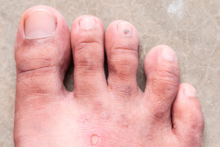 Mùi hôi chân do nhiễm nấm ở bàn chân