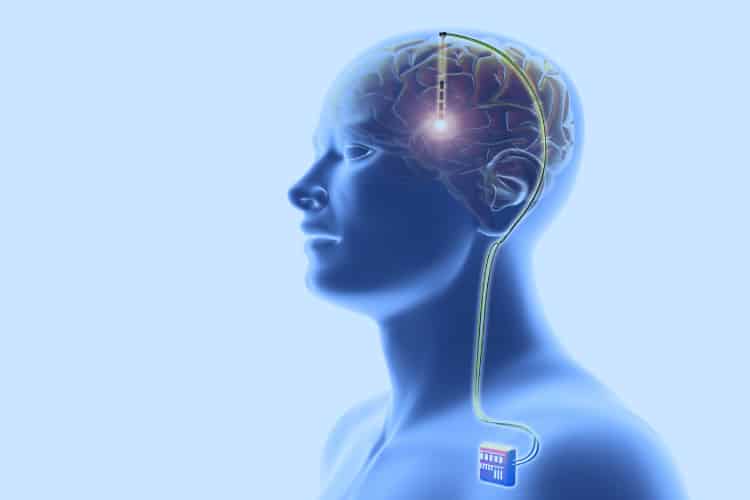 Kỹ thuật kích thích não sâu gồm 3 phần cấy ghép: điện cực, dây dẫn và thiết bị phát xung điện 