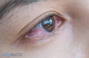 giảm thiểu đỏ mắt bằng cách sử dụng các thuốc nhỏ mắt