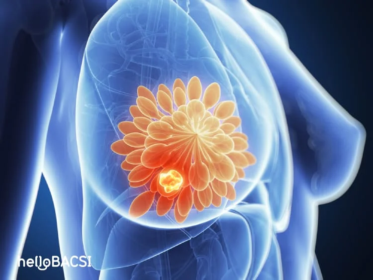 khối u vú: Ung thư vú giai đoạn 2 sống được bao lâu