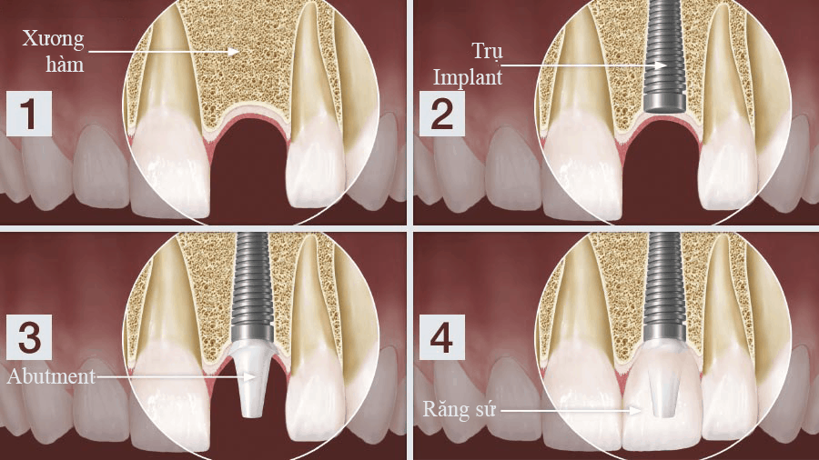Mô phỏng quy trình trồng răng Implant