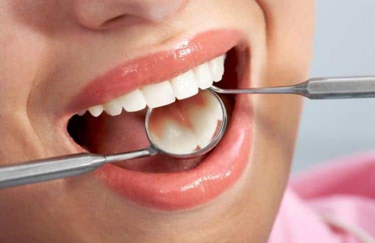 chữa tủy răng bao lâu