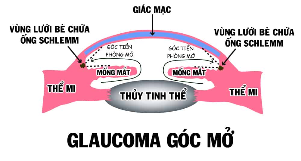 Nguyên nhân bị cườm nước (glaucoma) góc mở