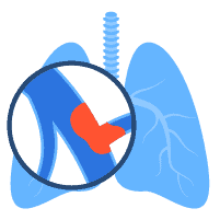 Thuyên tắc phổi