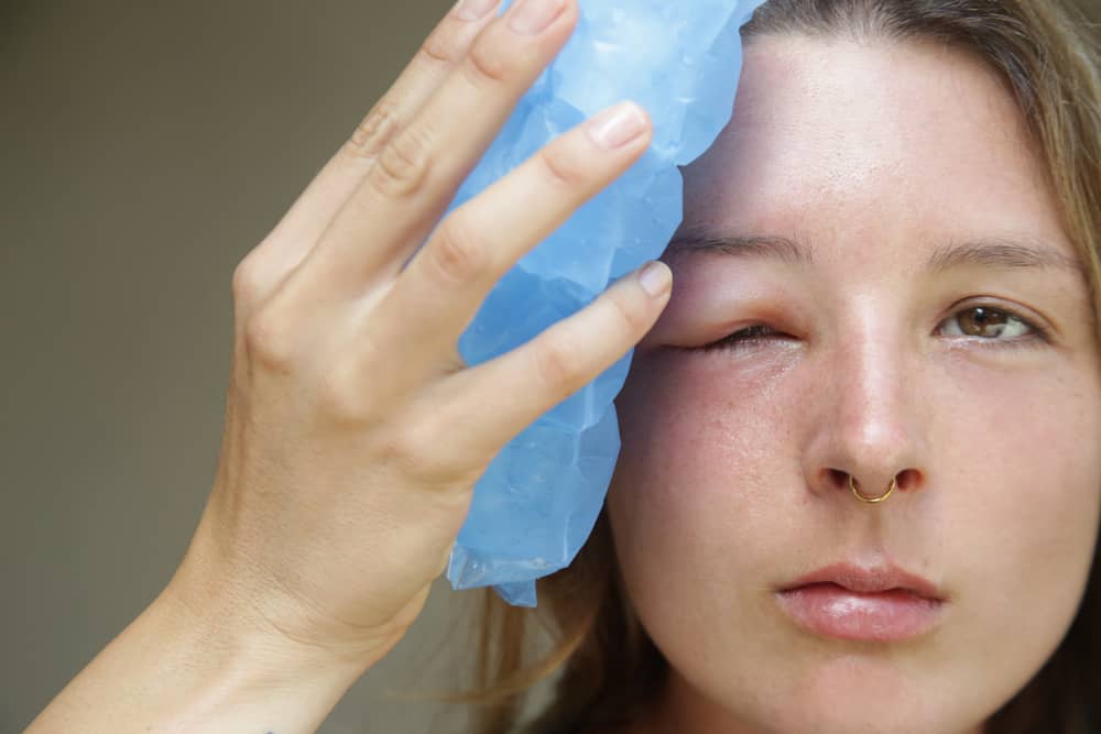 cách chữa mí mắt trên bị sưng