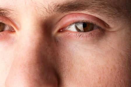 Mắt bị sưng mí trên: Nguyên nhân do đâu và cách điều trị?