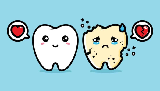 Răng khôn có thể bị sâu không? Lý do và cách xử lý