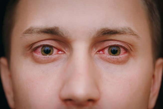 Điểm danh các cách trị đỏ mắt hiệu quả