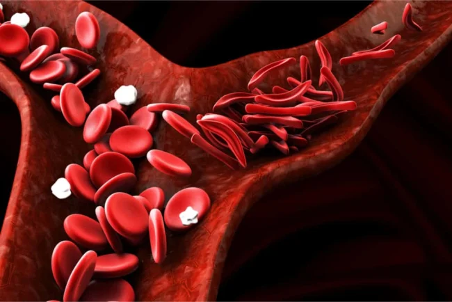 Bệnh hồng cầu lưỡi liềm: 10 biến chứng đáng lo ngại