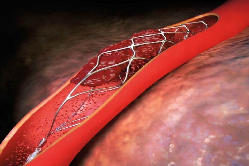 chụp động mạch vành giúp chẩn đoán nhồi máu cơ tim