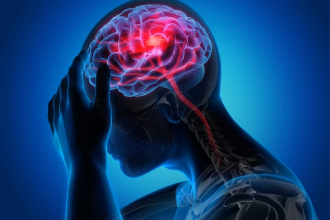 Vỡ phình mạch não (vỡ mạch máu não) là gì? Nguyên nhân, triệu chứng và điều trị