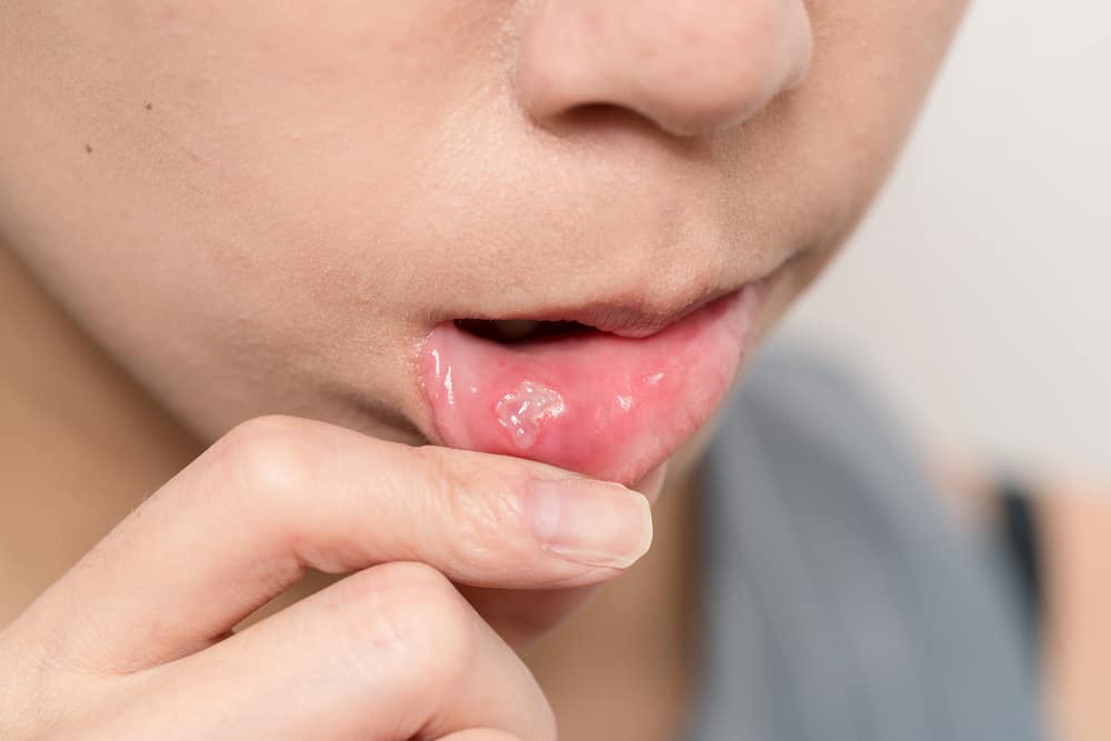 nổi mụn trong miệng do herpes