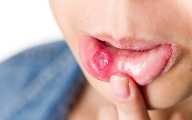Nổi mụn trong miệng là dấu hiệu của bệnh gì?