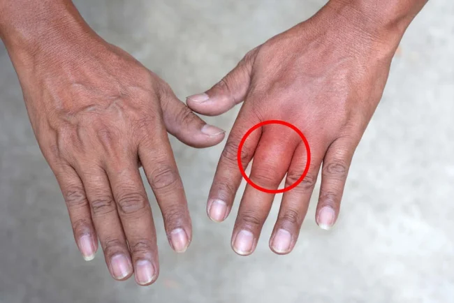 Ngón tay bị sưng là do đâu và cách chữa trị hiệu quả