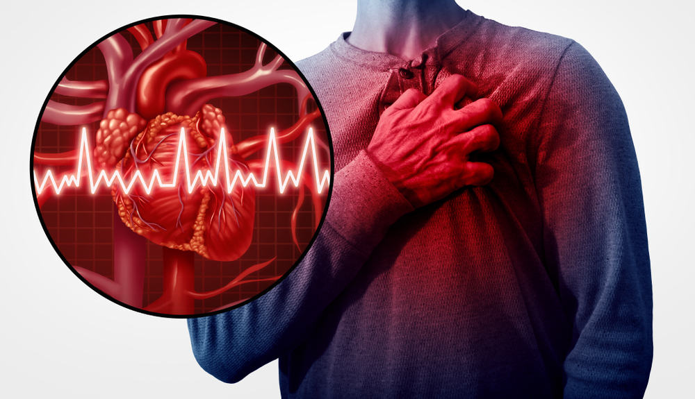 triệu chứng bệnh mạch vành là đau tim