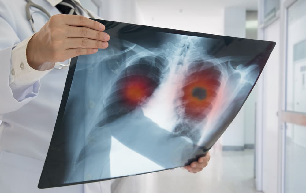 chẩn đoán và điều trị ung thư màng phổi