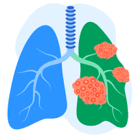 Sàng lọc ung thư phổi