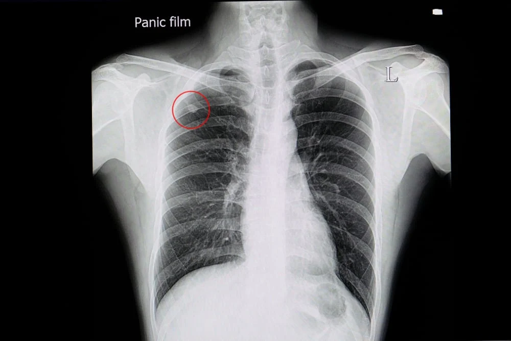 hình ảnh vôi hóa phổi trên x quang