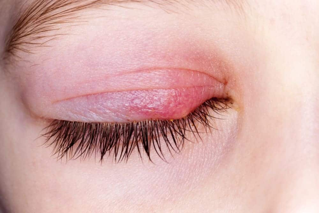 4 dấu hiệu bị lẹo mắt: Nhận biết sớm để chữa khỏi nhanh