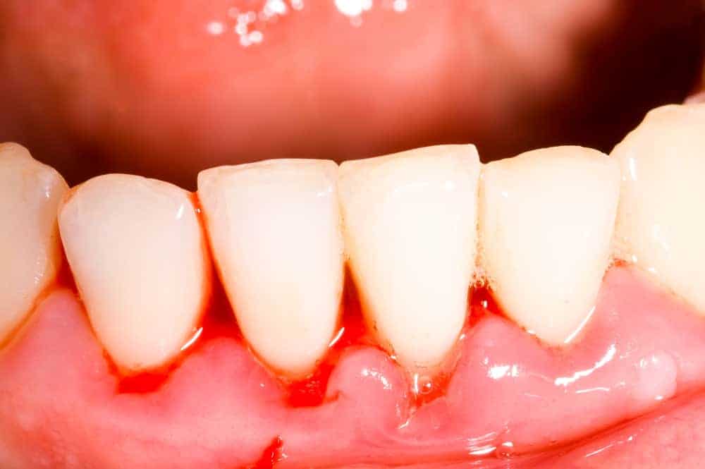 Triệu chứng thiếu vitamin C: chảy máu răng
