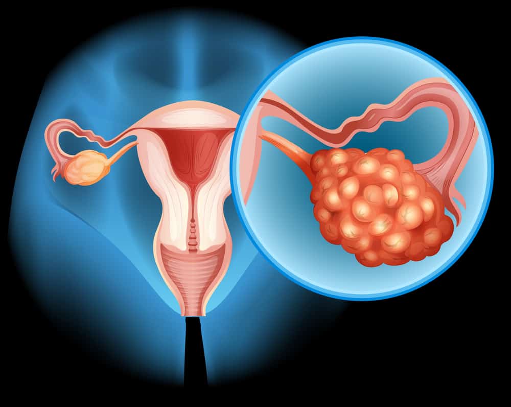 ung thư buồng trứng giai đoạn 3