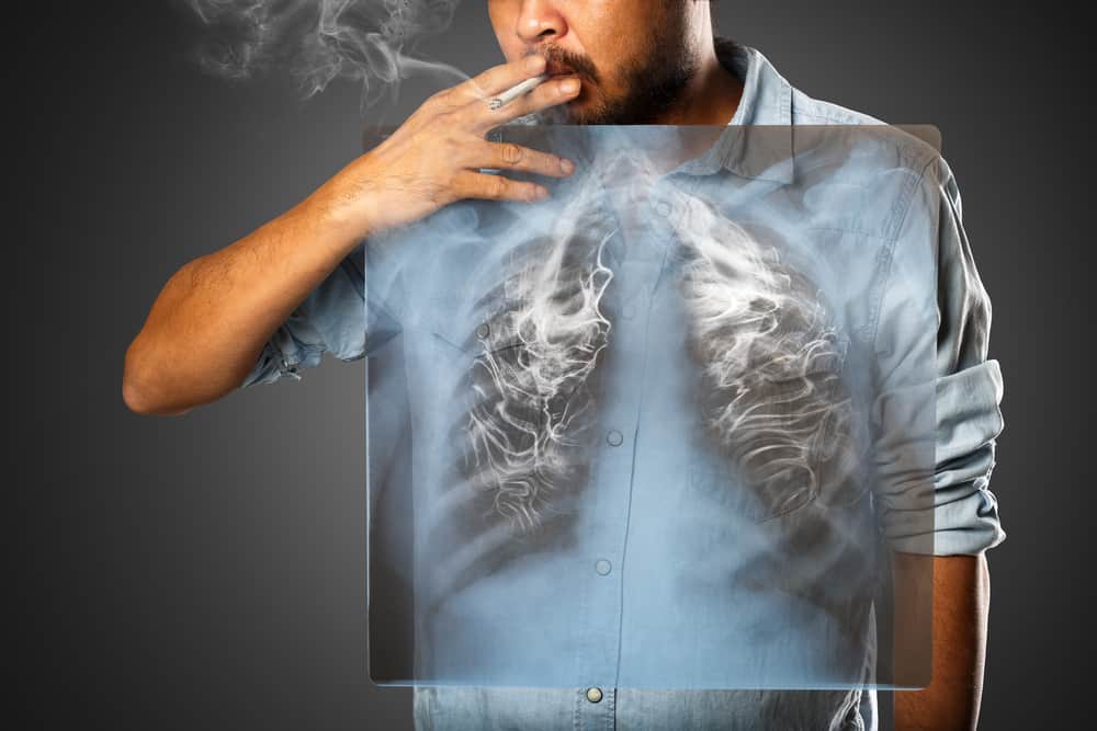 nguyên nhân ung thư biểu mô tuyến phổi là do hút thuốc lá
