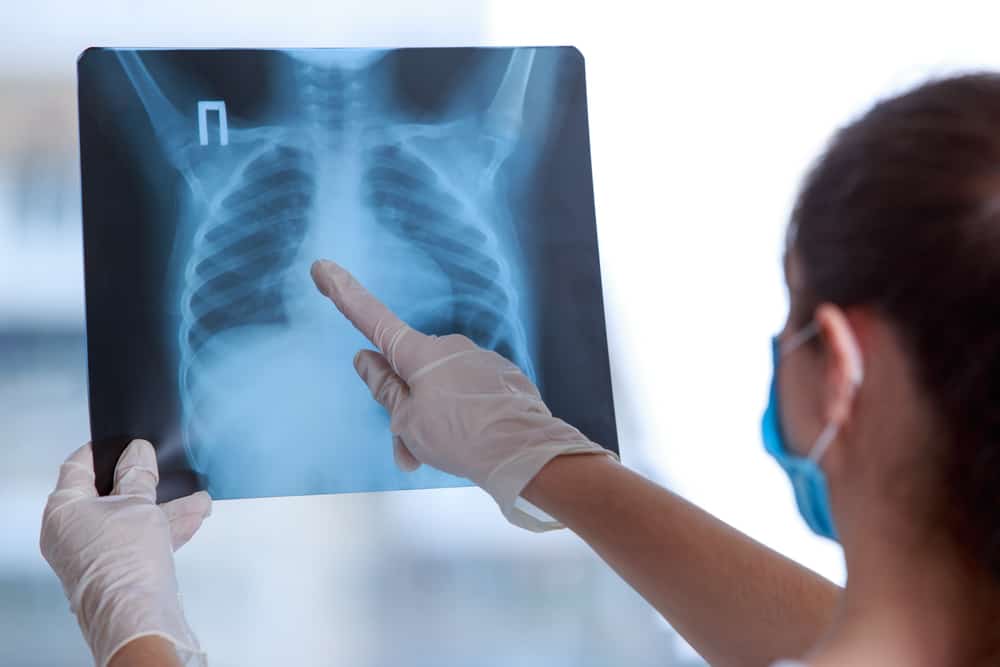 x quang tràn dịch màng phổi giúp chẩn đoán bệnh
